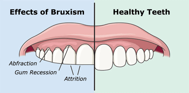 Image showing attrition, abfraction of teeth due to bruxism. 