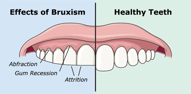 Image showing attrition, abfraction of teeth due to bruxism.