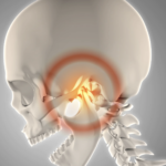 Bruxism causes TMJ pain due to grinding of opposing articular surfaces.